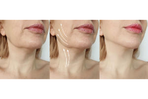 CHIN & JAWLINE CONTOUR