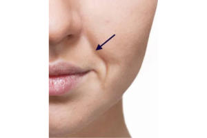 NASIO-LABIAL FOLDS