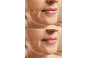 PERI-ORAL WRINKLES
